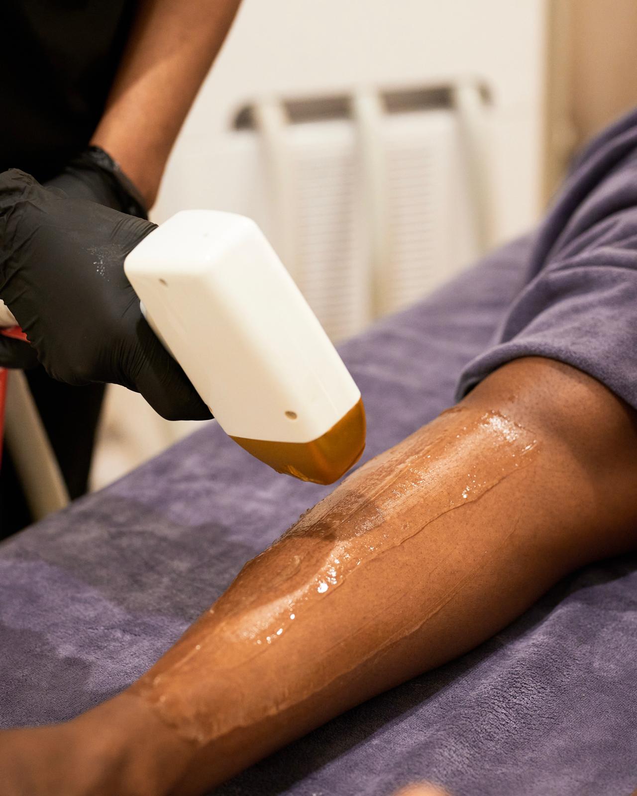 L’épilation laser